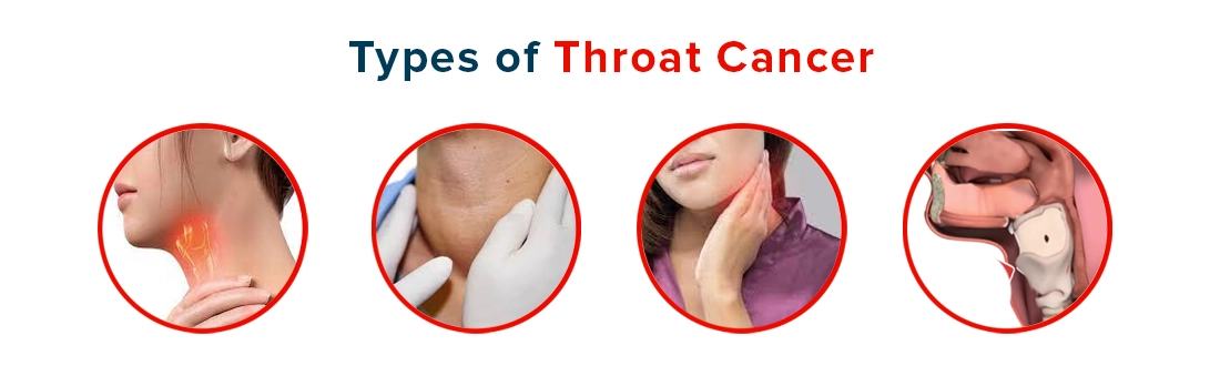 Types of Throat Cancer